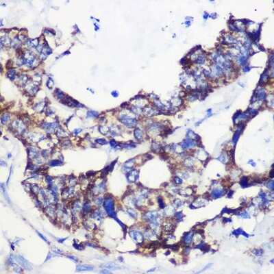 Immunohistochemistry-Paraffin: ACSS1 Antibody [NBP2-92202] - Immunohistochemistry of paraffin-embedded Human colon carcinoma using ACSS1 Rabbit pAb (NBP2-92202) at dilution of 1:100 (40x lens). Perform microwave antigen retrieval with 10 mM PBS buffer pH 7.2 before commencing with IHC staining protocol.