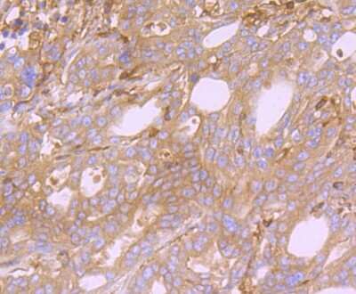 Immunohistochemistry-Paraffin: ACTR3 Antibody (JB33-44) [NBP2-75395] - Analysis of paraffin-embedded human stomach cancer tissue using anti-Arp3 antibody. Counter stained with hematoxylin.