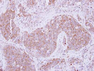 Immunohistochemistry-Paraffin: ADAM10 Antibody [NBP2-15280] - Paraffin-embedded Lung Papillary Adenocarcinoma, using antibody at 1:250 dilution.