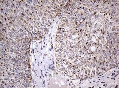 Immunohistochemistry: ADAMTS1 Antibody (OTI4H2) - Azide and BSA Free [NBP2-71474] - Paraffin-embedded Carcinoma of Human bladder tissue using antiADAMTS1 mouse monoclonal antibody. Dilution: 1:150