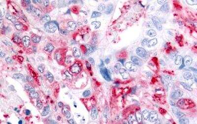 Immunohistochemistry-Paraffin: ADAMTS5 Antibody [NLS7761] - Colon, Carcinoma