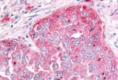 Immunohistochemistry-Paraffin: ADAMTS5 Antibody [NLS7768] - Anti-ADAMTS5 antibody IHC of human Lung, Non-Small Cell Carcinoma. Immunohistochemistry of formalin-fixed, paraffin-embedded tissue after heat-induced antigen retrieval.