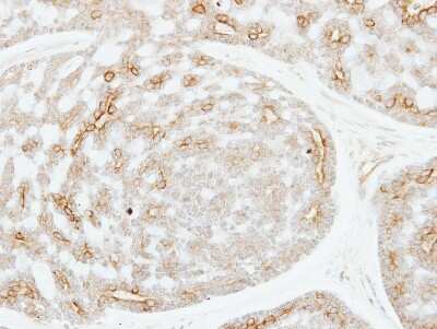 Immunohistochemistry-Paraffin: ADPGK Antibody [NBP1-32429] - Paraffin-embedded Breast ca, using antibody at 1:250 dilution.