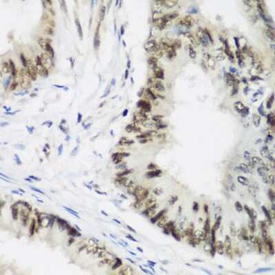 Immunohistochemistry-Paraffin: AEBP2 Antibody [NBP2-92913] - Paraffin-embedded human colon carcinoma using AEBP2 .