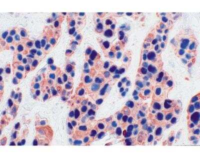 AEC Substrate Kit [SK-4200-NB] - Tumor (double label): p53 (m), VECTASTAIN ABC-AP Kit, Vector Blue substrate (blue). Multi-Cytokeratin (m), VECTASTAIN Elite ABC Kit, AEC substrate (red).