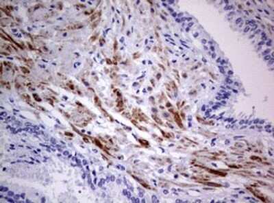 Immunohistochemistry: AFAP Antibody (2G9) [NBP2-46498] - Analysis of Carcinoma of Human prostate tissue. (Heat-induced epitope retrieval by 10mM citric buffer, pH6.0, 120C for 3min)