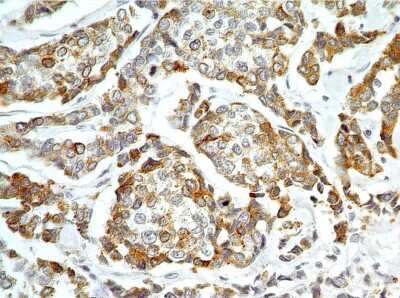 Immunohistochemistry-Paraffin: AG-2/AGR2 Antibody - Azide Free [NBP2-27392] - Formalin-fixed, paraffin-embedded human adenocarcinoma of the breast stained with AGR2 antibody (2 ug/ml), peroxidase-conjugate and DAB chromogen. Staining of formalin-fixed tissues is enhanced by boiling tissue sections in 10 mM sodium citrate buffer, pH 6.0 for 10-20 min followed by cooling at RT for 20 min.