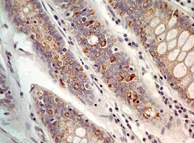 Immunohistochemistry-Paraffin: AG-2/AGR2 Antibody - Azide Free [NBP2-27392] - Formalin-fixed, paraffin-embedded human adenocarcinoma of the colon stained with AGR2 antibody (2-5 ug/ml), peroxidase-conjugate and DAB chromogen.  Staining of formalin-fixed tissues is enhanced by boiling tissue sections in 10 mM sodium citrate buffer, pH 6.0 for 10-20 min followed by cooling at RT for 20 min.