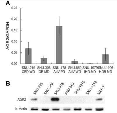 Western Blot: AG-2/AGR2 Antibody - Azide Free [NBP2-27392] - AGR2 expression in cancer cell lines of the biliary tract. AGR2 mRNA levels in six biliary tract cancer cell lines were measured by real-time RT-PCR. The AGR2 transcript levels were normalized against those of the GAPDH. Results shown are means +/- standard deviations of (1/2)CT of target - CT of GAPDH of three experiments. B. AGR2 protein expression was detected by western blot analysis with beta-actin as a loading control. The result shown is a representative of three experiments. Abbreviations: CBD, common bile duct; GB, gall bladder; AoV, ampulla of Vater; IHD, intrahepatic duct; HDB, hepatic duct bifurcation; WD, well differentiated; MD, moderately differentiated; PD, poorly differentiated [24]. Image collected and cropped by CiteAb from the following publication (//bmccancer.biomedcentral.com/articles/10.1186/1471-2407-14-804), licensed under a CC-BY license. Image using the standard format of this product.