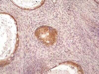 Immunohistochemistry: AG-2/AGR2 Antibody (10E2) - Azide and BSA Free [NBP2-80564] - IHC-P detection of AGR2 protein in a human ovarian cancer section using 5 ug/ml concentration of AGR2 antibody. The representative image shows AGR2 immuno-reactivity in the developing ovarian cancer and the follicle cells of Graafian follicles. The cells