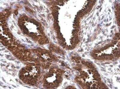 Immunohistochemistry-Paraffin: AG-2/AGR2 Antibody (GT5812) [NBP3-13593] - AG-2/AGR2 antibody [GT5812] detects secreted AG-2/AGR2 protein by immunohistochemical analysis. Sample: Paraffin-embedded human breast carcinoma. AG-2/AGR2 stained by AG-2/AGR2 antibody [GT5812] (NBP3-13593) diluted at 1:200. Antigen Retrieval: Citrate buffer, pH 6.0, 15 min