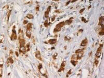 Immunohistochemistry: AG-3/AGR3 Antibody (AGR3.1) [NBP1-45004] - Staining of AGR3 with mouse monoclonal AGR3.1 in paraffin-embedded sections of breast carcinoma. 