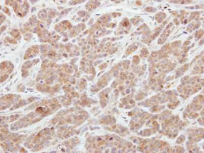 Immunohistochemistry-Paraffin: AGAP1 Antibody [NBP2-15305] - MDAMB231 xenograft, using Centaurin gamma 2  antibody at 1:250 dilution. Antigen Retrieval: Citrate buffer, pH 6.0, 15 min. 