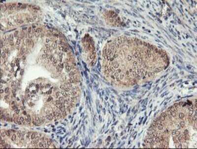 Immunohistochemistry: AGPAT5 Antibody (OTI2C4) - Azide and BSA Free [NBP2-72002] - Staining of paraffin-embedded Adenocarcinoma of Human endometrium tissue using anti-AGPAT5 mouse monoclonal antibody.