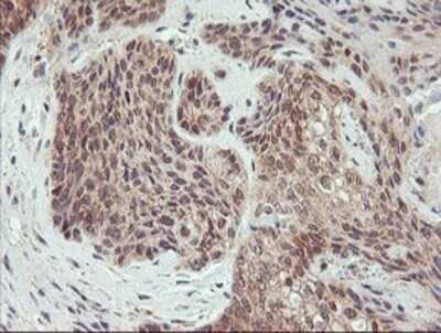 Immunohistochemistry: AGPAT5 Antibody (OTI2C4) - Azide and BSA Free [NBP2-72002] - Staining of paraffin-embedded Carcinoma of Human bladder tissue using anti-AGPAT5 mouse monoclonal antibody.
