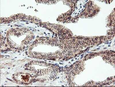 Immunohistochemistry: AGPAT5 Antibody (OTI2C4) - Azide and BSA Free [NBP2-72002] - Staining of paraffin-embedded Carcinoma of Human prostate tissue using anti-AGPAT5 mouse monoclonal antibody.