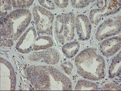 Immunohistochemistry: AGTPBP1 Antibody (9A3) [NBP2-46502] - Analysis of Carcinoma of Human prostate tissue.