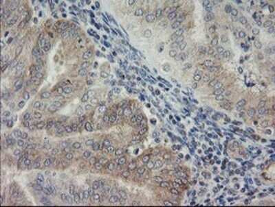 Immunohistochemistry: AGTPBP1 Antibody (OTI9A3) - Azide and BSA Free [NBP2-71734] - Analysis of Adenocarcinoma of Human endometrium tissue.