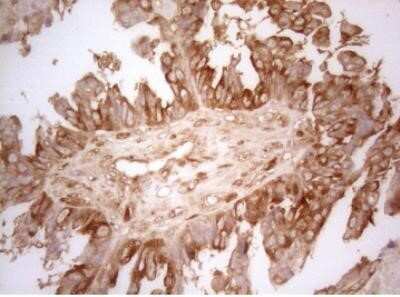 Immunohistochemistry: AHSA1 Antibody (OTI1D2) - Azide and BSA Free [NBP2-71608] - Staining of paraffin-embedded Adenocarcinoma of Human ovary tissue using antiAHSA1 mouse monoclonal antibody.(Heat-induced epitope retrieval by 1mM EDTA in 10mM Tris buffer (pH8.5) at 120 degrees C for 3 min, 1:150)