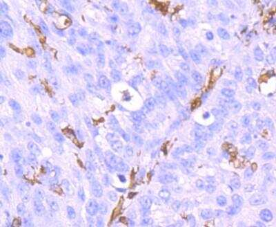 Immunohistochemistry-Paraffin: AIF-1/Iba1 Antibody (JM36-62) [NBP2-75397] - Analysis of paraffin-embedded human lung cancer tissue using AIF-1/Iba1 Antibody (JM36-62). Counterstained with hematoxylin.