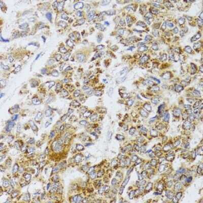 Immunohistochemistry-Paraffin: AIFM3 Antibody [NBP2-92837] - Paraffin-embedded human liver cancer using AIFM3 .