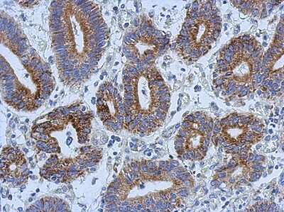 Immunohistochemistry-Paraffin: AK3L1 Antibody [NBP2-15317] - Paraffin-embedded Colon ca, using antibody at 1:500 dilution.