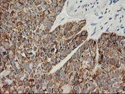 Immunohistochemistry: AK3L1 Antibody (OTI3B1) - Azide and BSA Free [NBP2-70129] - Staining of paraffin-embedded Adenocarcinoma of Human breast tissue using anti-AK3L1 mouse monoclonal antibody.