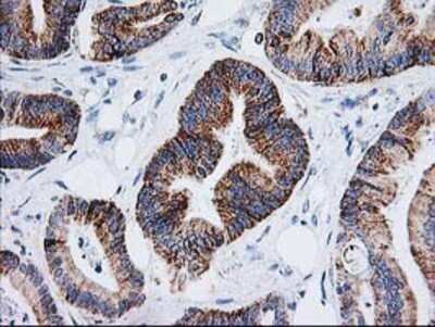 Immunohistochemistry: AK3L1 Antibody (OTI3B1) - Azide and BSA Free [NBP2-70129] - Staining of paraffin-embedded Adenocarcinoma of Human colon tissue using anti-AK3L1 mouse monoclonal antibody.