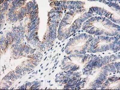 Immunohistochemistry: AK3L1 Antibody (OTI3B1) - Azide and BSA Free [NBP2-70129] - Staining of paraffin-embedded Adenocarcinoma of Human endometrium tissue using anti-AK3L1 mouse monoclonal antibody.