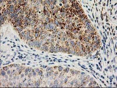 Immunohistochemistry: AK3L1 Antibody (OTI3B1) - Azide and BSA Free [NBP2-70129] - Staining of paraffin-embedded Carcinoma of Human bladder tissue using anti-AK3L1 mouse monoclonal antibody.