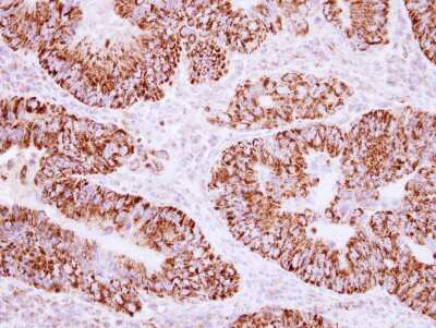 Immunohistochemistry-Paraffin: AKAP1 Antibody [NBP2-15319] - Human colon carcinoma, using AKAP1 antibody at 1:250 dilution. Antigen Retrieval: Trilogy™ (EDTA based, pH 8.0) buffer, 15min.