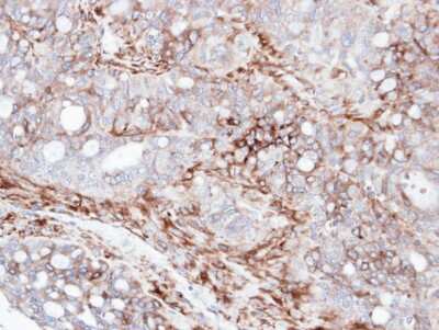 Immunohistochemistry-Paraffin: AKAP12 Antibody [NBP1-31482] - Paraffin-embedded serous OVCA, using antibody at 1:100 dilution.