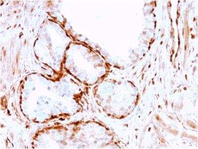 Immunohistochemistry-Paraffin: AKR1B1 Antibody (CPTC-AKR1B1-3) - Azide and BSA Free [NBP2-79930] - Formalin-fixed, paraffin-embedded human Prostate Tumor stained with AKR1B1 Mouse Monoclonal Antibody (CPTC-AKR1B1-3).