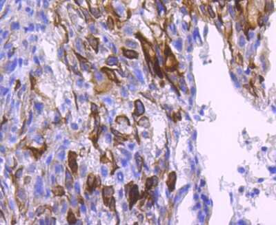 Immunohistochemistry-Paraffin: AKT1 [p Ser124] Antibody (JJ08-46) [NBP2-67862] - IHC analysis of paraffin-embedded human breast carcinoma tissue using anti-Phospho-AKT1(Ser124) antibody. Counter-stained with hematoxylin.