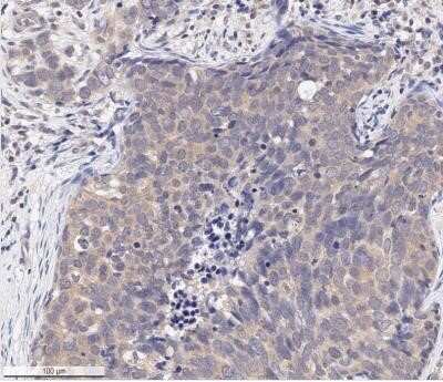 Immunohistochemistry: AKT1 [p Ser473] Antibody (104A282) - Azide and BSA Free [NBP2-27399] - IHC analysis of an FFPE human breast carcinoma tissue section using 1:250 dilution of phospho Ser473 AKT1 antibody (clone 104A282) on a Bond Rx autostainer (Leica Biosystems). The assay involved 20 minutes of heat induced antigen retrieval (HIER) with 10 mM sodium citrate buffer (pH 6.0) and endogenous peroxidase quenching using peroxide block. The sections were incubated with primary antibody for 30 minutes. Bond Polymer Refine Detection (Leica Biosystems) and DAB were used for signal detection which followed counterstaining with hematoxylin. Whole slide scanning and capturing of representative images (20X) were performed using Aperio AT2 (Leica Biosystems). This antibody generated a diffused cytoplasmic staining of phosphor-AKT (Ser-473) in the cancer cells as well as the stromal cells. Staining was performed by Histowiz. Image using the standard format of this product.