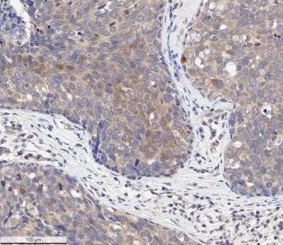 Immunohistochemistry-Paraffin: AKT1 [p Ser473] Antibody (104A282) - Azide and BSA Free [NBP2-27399] - IHC analysis of an FFPE human breast carcinoma tissue section @ 1:250 of pSer473 AKT1 antibody (clone 104A282) on a Bond Rx autostainer (Leica Biosystems). Assay: 20 mins of heat induced antigen retrieval (HIER) with 10 mM sodium citrate buffer (pH 6.0) & endogenous peroxidase quenching using peroxide block. Sections incubated with primary antibody for 30 mins. Bond Polymer Refine Detection (Leica Biosystems) & DAB used for signal detection following counterstaining with hematoxylin. Whole slide scanning & capturing of representative images (20X) performed using Aperio AT2 (Leica Biosystems). Antibody generated diffused cytoplasmic staining of phospho-AKT (Ser-473) in the cancer cells as well as the stromal cells. Some cancer cells depicted nuclear staining also. Staining was performed by Histowiz. Image using the standard format of this product.