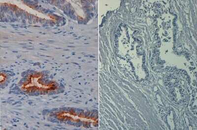 Immunohistochemistry: AKT1 [p Ser473] Antibody (17F6.B11) [Biotin] [NBP2-21678] - Immunohistochemistry of AKT11 [p Ser473] antibody (17F6.B11) [Biotin]. Tissue: prostate at 40X (left) with negative control (right).Fixation: FFPE buffered formalin 10% conc.Antigen retrieval: Heat, Citrate pH 6.2. Pressure Cooker. Primary antibody: AKT1 pS473 biotin at 20 ug/mL for 1 h at RT.Secondary antibody: Streptavidin Conj. HRP at 10 ug/ml.Localization: nuclear and occasionally cytoplasmic.Staining: antibody as precipitated red signal with a hematoxylin purple nuclear counterstain.