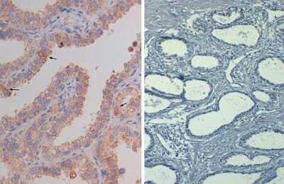 Immunohistochemistry: AKT1 [p Ser473] Antibody (17F6.B11) [Biotin] [NBP2-21678] - Immunohistochemistry of AKT11 [p Ser473] antibody (17F6.B11) [Biotin]. Tissue: prostate at 40X. Fixation: FFPE buffered formalin 10% conc.Antigen retrieval: Heat, Citrate pH 6.2. Pressure Cooker, left. (pH 9 shown on right as negative control). Primary antibody: AKT1sS473 biotin 20 ug/mL for 1 h at RT.Secondary antibody: Streptavidin Conj. HRP at 10 ug/ml.Localization: nuclear and occasionally cytoplasmic.Staining: antibody as precipitated red signal with a hematoxylin purple nuclear counterstain.