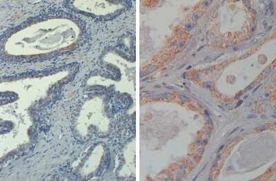 Immunohistochemistry: AKT1 [p Thr308] Antibody (18F3.H11) [Biotin] [NBP2-21679] - IHC-P analysis of FFPE human prostate tissue using AKT1 phospho Thr308 antibody at 20 ug/mL. Left panel: 20X magnification. Right panel: 40X magnification. Heat antigen retrieval in citrate buffer pH 6.2. Secondary antibody: streptavidin-HRP at 10 ug/mL. Antibody as precipitated red signal with hemotoxylin purple nuclear counterstain.