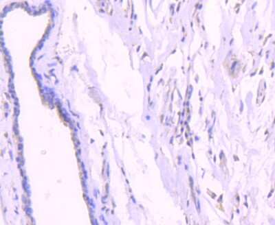 Immunohistochemistry-Paraffin: AKT1 [p Thr450] Antibody (SD08-12) [NBP2-67806] - IHC analysis of paraffin-embedded human breast carcinoma tissue using anti-Phospho-AKT1(Thr450) antibody. Counter-stained with hematoxylin.
