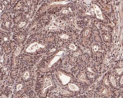 Immunohistochemistry-Paraffin: AKT1 [p Thr450] Antibody (SD08-12) [NBP2-67806] - Analysis of paraffin-embedded human breast carcinoma tissue using anti-Phospho-AKT1 [p Thr450] antibody. The section was pre-treated using heat mediated antigen retrieval with Tris-EDTA buffer (pH 8.0-8.4) for 20 minutes.The tissues were blocked in 5% BSA for 30 minutes at room temperature, washed with ddH2O and PBS, and then probed with the primary antibody (1/50) for 30 minutes at room temperature. The detection was performed using an HRP conjugated compact polymer system. DAB was used as the chromogen. Tissues were counterstained with hematoxylin and mounted with DPX.