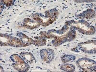 Immunohistochemistry: ALDH1A3 Antibody (OTI4E8) - Azide and BSA Free [NBP2-70154] - Analysis of Carcinoma of Human prostate tissue. (Heat-induced epitope retrieval by 10mM citric buffer, pH6.0, 120C for 3min)