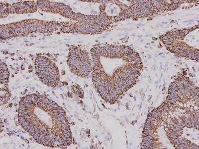 Immunohistochemistry-Paraffin: ALDH2 Antibody (7-D8) [NBP2-67131] - Analysis of paraffin-embedded human colon carcinoma tissue using anti- ALDH2 mouse mAb.