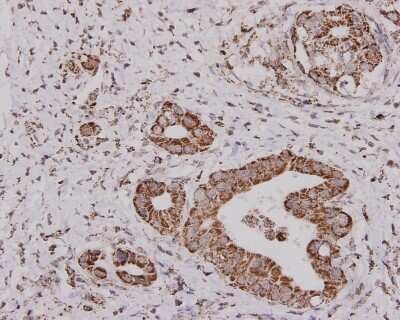 Immunohistochemistry-Paraffin: ALDH2 Antibody (7-D8) [NBP2-67131] - Analysis of paraffin-embedded human gastric carcinoma tissue using anti-ALDH2 mouse mAb.