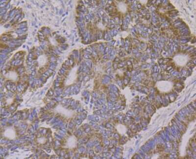 Immunohistochemistry-Paraffin: ALDH4A1 Antibody (7E3) [NBP2-75401] - Analysis of paraffin-embedded human colon cancer tissue using anti-ALDH4A1 antibody. Counter stained with hematoxylin.