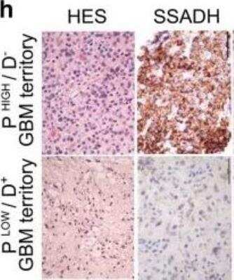 Immunohistochemistry: ALDH5A1 Antibody (17F5) [NBP2-59409] - SSADH immunoreactive cells are enriched in proliferative/non-differentiated GBM territories (PHIGH/D-) and rare in non-proliferative/differentiated (PLOW/D+) tumor territories of patients' GBM, as revealed by immunohistochemical staining. HES: hematoxylin and eosin staining. Scale bar 100 um. Image collected and cropped by CiteAb from the following publication (link.springer.com/10.1007/s00401-016-1659-5), licensed under a CC-BY license.