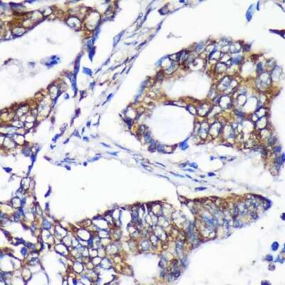 Immunohistochemistry-Paraffin: ALG5 Antibody [NBP2-92371] - Immunohistochemistry of paraffin-embedded Human colon carcinoma using ALG5 Rabbit pAb (NBP2-92371) at dilution of 1:100 (40x lens). Perform microwave antigen retrieval with 10 mM PBS buffer pH 7.2 before commencing with IHC staining protocol.