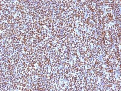 Immunohistochemistry-Paraffin: ALK/CD246 Antibody (ALK/1504) - Azide and BSA Free [NBP3-08446] - Formalin-fixed, paraffin-embedded human Anaplastic LC Lymphoma stained with ALK/CD246 Mouse Monoclonal Antibody (ALK/1504).