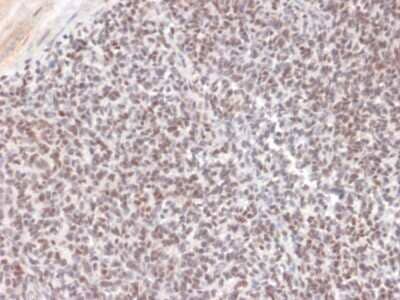 Immunohistochemistry-Paraffin: ALK/CD246 Antibody (ALK/1504) - Azide and BSA Free [NBP3-08446] - Formalin-fixed, paraffin-embedded human Ewing Sarcoma stained with ALK/CD246 Mouse Monoclonal Antibody (ALK/1504).