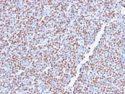 Immunohistochemistry-Paraffin: ALK/CD246 Antibody (ALK1/2766R) - Azide and BSA Free [NBP3-08447] - Formalin-fixed, paraffin-embedded human Anaplastic LC Lymphoma stained with ALK/CD246 Recombinant Rabbit Monoclonal Antibody (ALK1/2766R).